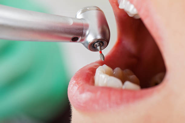 Best Knocked-Out Tooth (Avulsed Tooth) Treatment in Eastwood, LA